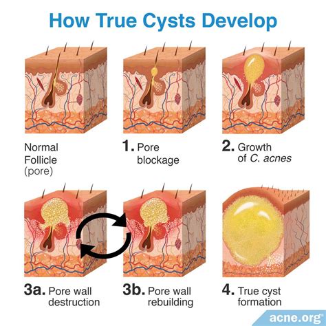 What Is an Acne Cyst? - Acne.org