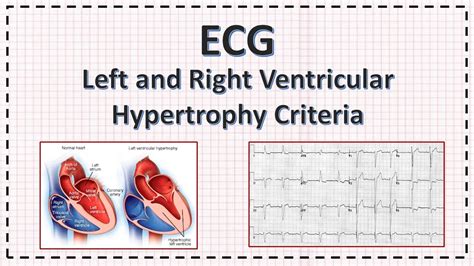 Lv Hypertrophy Ekg | Natural Resource Department