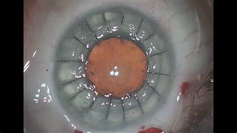 Cornea Transplant Video