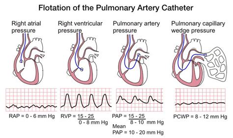 PA catheter, Pressures | Nerdy nurse, Critical care nursing, Icu nursing