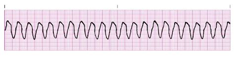 Dr. Smith's ECG Blog: Polymorphic Ventricular Tachycardia