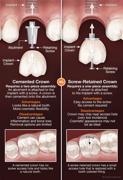 How Crowns Attach to Dental Implants