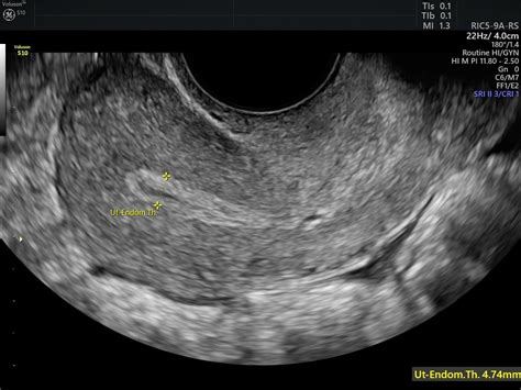 Measuring Endometrial Thickness in Postmenopausal Women | Empowered ...