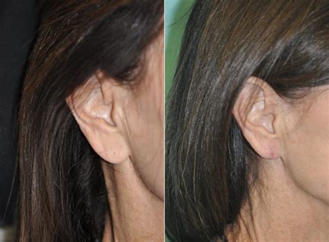 Ear Lobe Repair photos | Chevy Chase, MD | Patient 11961