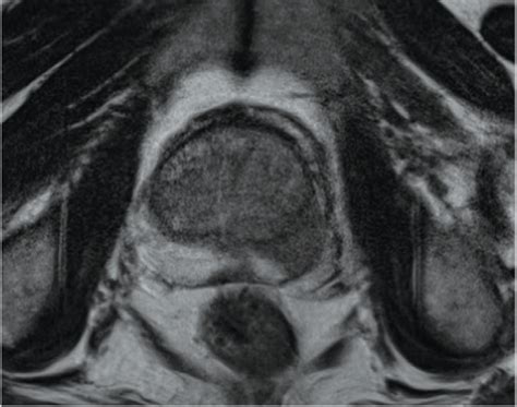 Prostate Cancer Risk Stratification Enhanced by Novel MRI Protocol ...