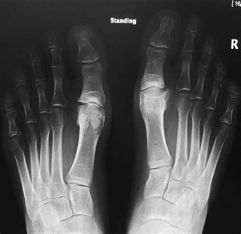 Big Toe Arthritis | Arthritis Treatment & Surgery | David Redfern