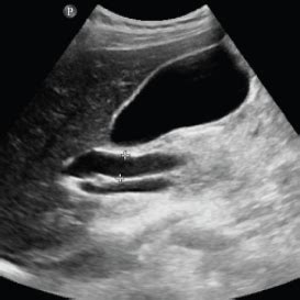 Doppler Ultrasound Identified Venous Congestion in Septic Shock ...