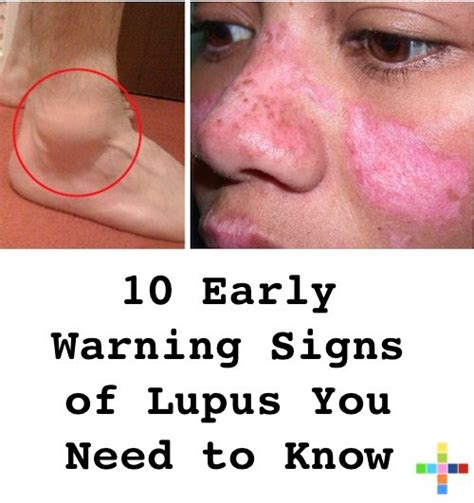 10 Early Warning Signs of Lupus You Need to Know