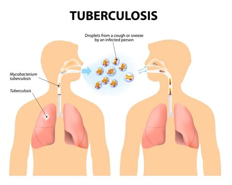 TB Free India programme launched - Health Issues India