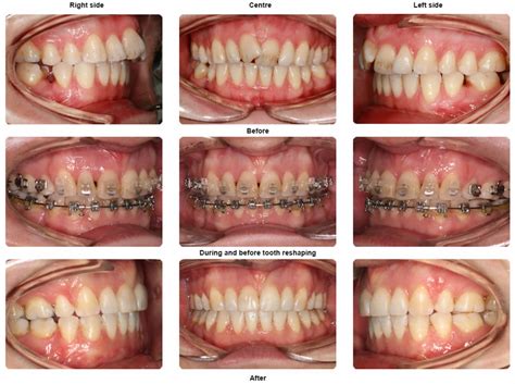 Braces Before and After Photo Gallery - orthodontics