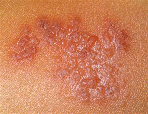 9 Common Rashes With Blisters