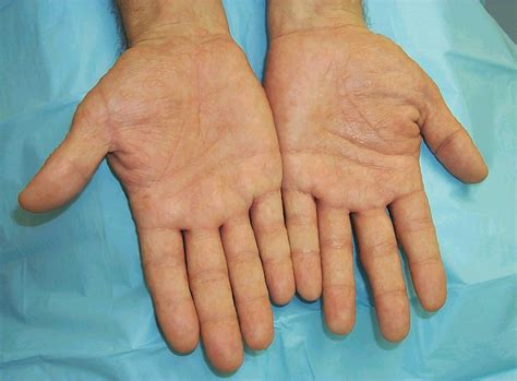 SKIN DISEASE TYPES: Vesicular Hand Dermatitis (Skin Disease type)