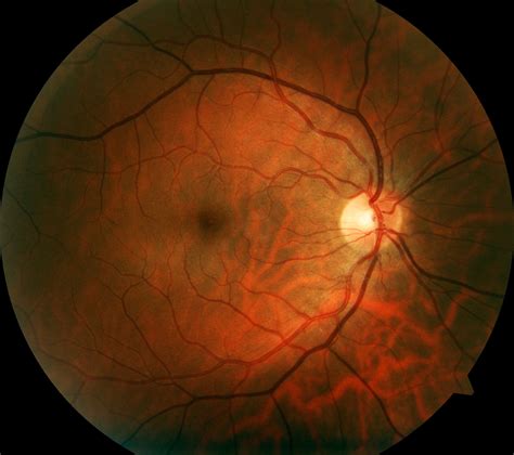 Mending Vision in Patients with Eye Vein Clots | National Institutes of ...