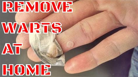 WART REMOVAL - HOW TO REMOVE WARTS AT HOME | Doovi