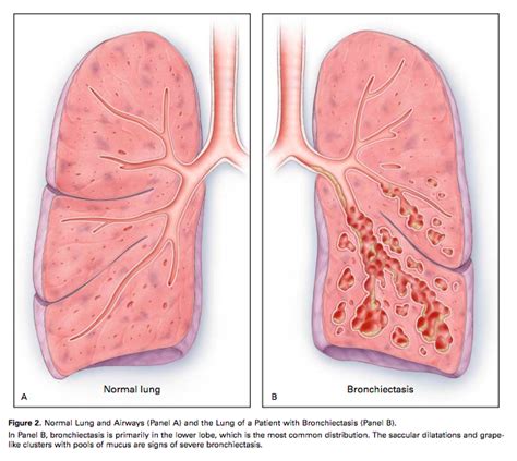 Bronchiectasis - Physiopedia