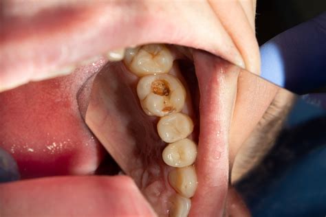 7 Early Signs of a Cavity Forming in Your Teeth – Cian Blog