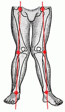 Knock Knees: Causes & Treatment Options | Orthopedic Blog | OrthoCarolina