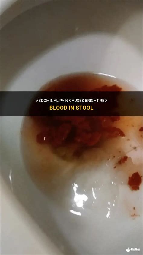 Abdominal Pain Causes Bright Red Blood In Stool | MedShun