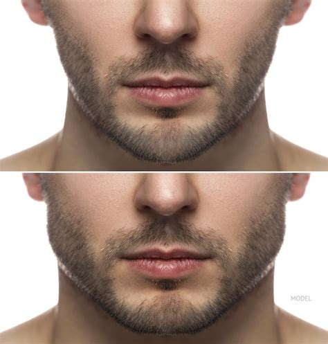 Will Jawline Contouring Increase Among Men in 2021? - Beverly Hills, CA ...