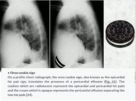 Pin by Juan Castro on radiological signs | Oreo cookies, Oreo, Cookies