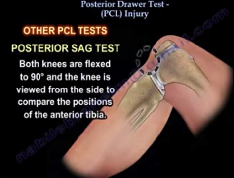 Posterior Drawer Test, #PCL Injury Tests — OrthopaedicPrinciples.com