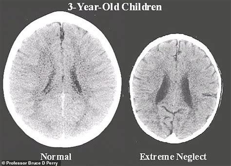 Scans of neglected children's brains reveal stunning differences ...