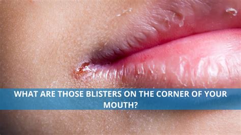 What are those blisters on the corner of your mouth?