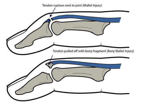 Mallet Finger Fracture