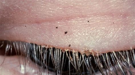 Eyelash Lice: Symptoms and Treatment Options