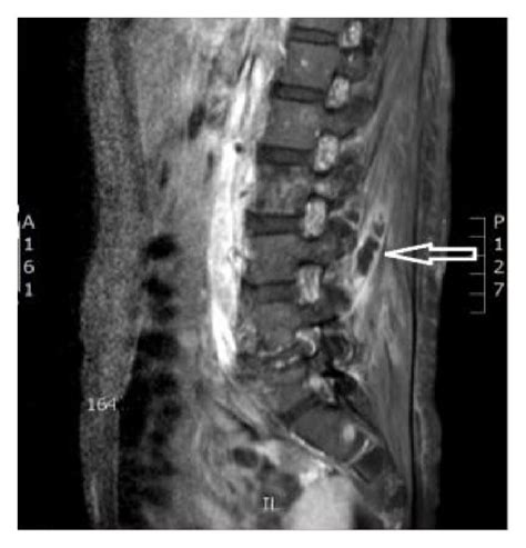 MRI lumbar spine. (a) MRI of the lumbar spine with contrast showing L2 ...