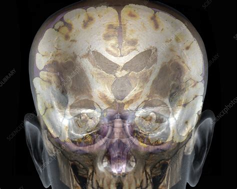 Human brain with ventricles, 3D CT and MRI scans - Stock Image - C051 ...