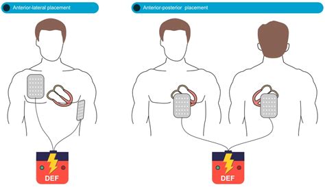 Advanced cardiopulmonary resuscitation (CPR) - Advanced cardiovascular ...