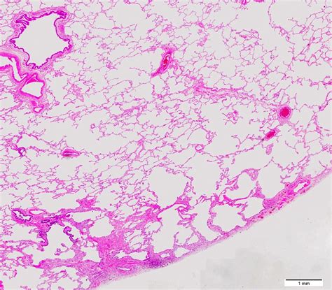 Pathology Outlines - Emphysema