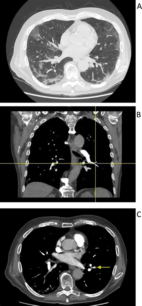 thorax contrast-enhanced CT scan images at admission. A Bilateral ...