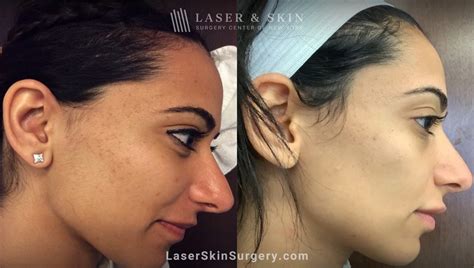 Laser Treatment For Acne Scars: Is It Actually Effective? - Laser NY