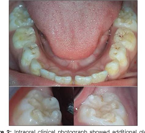 Nonsyphilitic occurrence of mulberry molars: A rare case report ...