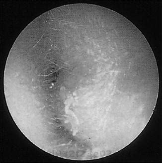 Infections of the External Ear | Ento Key