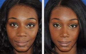 African American Rhinoplasty Beverly Hills - African American Nose Job LA