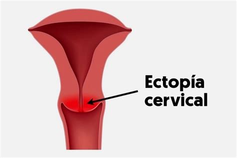 Tratamiento para sanar el ectropión/ectopia cervical