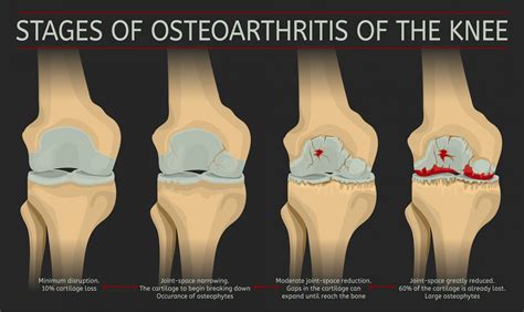 What Is Osteoarthritis Of The Knee Stages Symptoms Causes Diagnosis ...