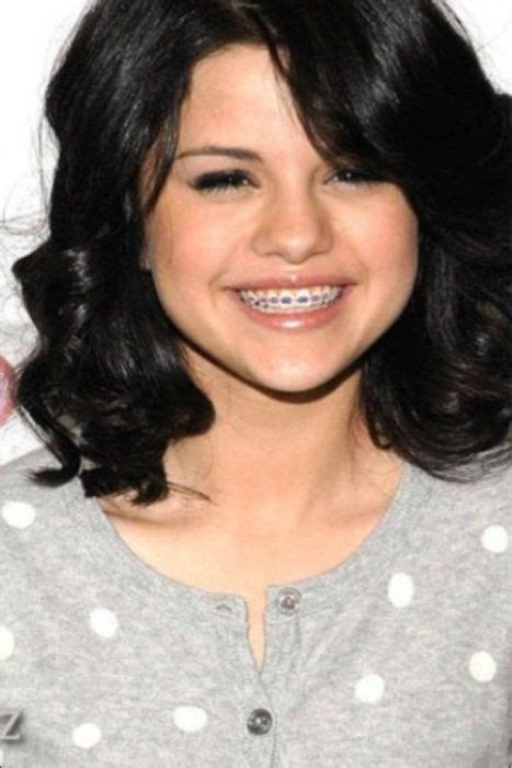 62 Best Braces on Celebrities! images | Braces, Celebrities with braces ...