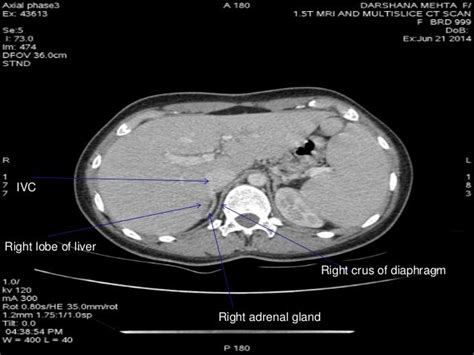 MRI and CT of ADRENAL GLAND