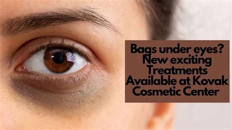 Non-Surgical Eye Lifts in Chicago | Under Eye Bags Removal & Treatment