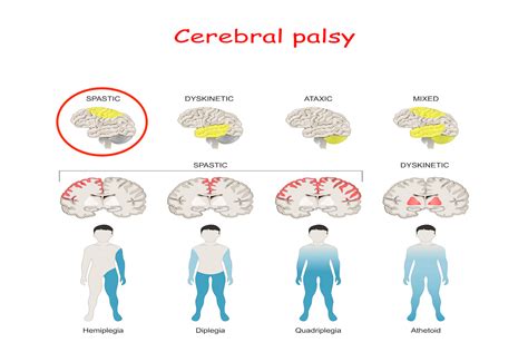 Spastic Cerebral Palsy | LegalFinders