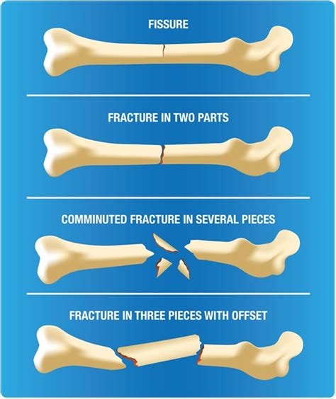 Bone Fractures: Types, Symptoms Treatment, 56% OFF