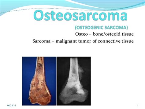 Osteosarcoma - Symptoms, Causes and Homeopathic Treatment ...