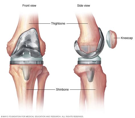 Knee replacement surgery - Mayo Clinic