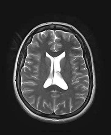 Ventricles Of The Brain Mri