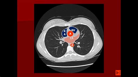 Normal Chest CT with labels - YouTube