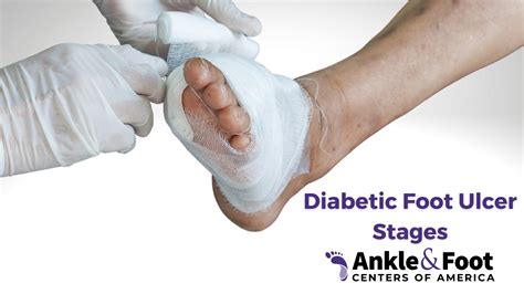 Diabetic Foot Ulcer Treatment & Prevention - What to Know!